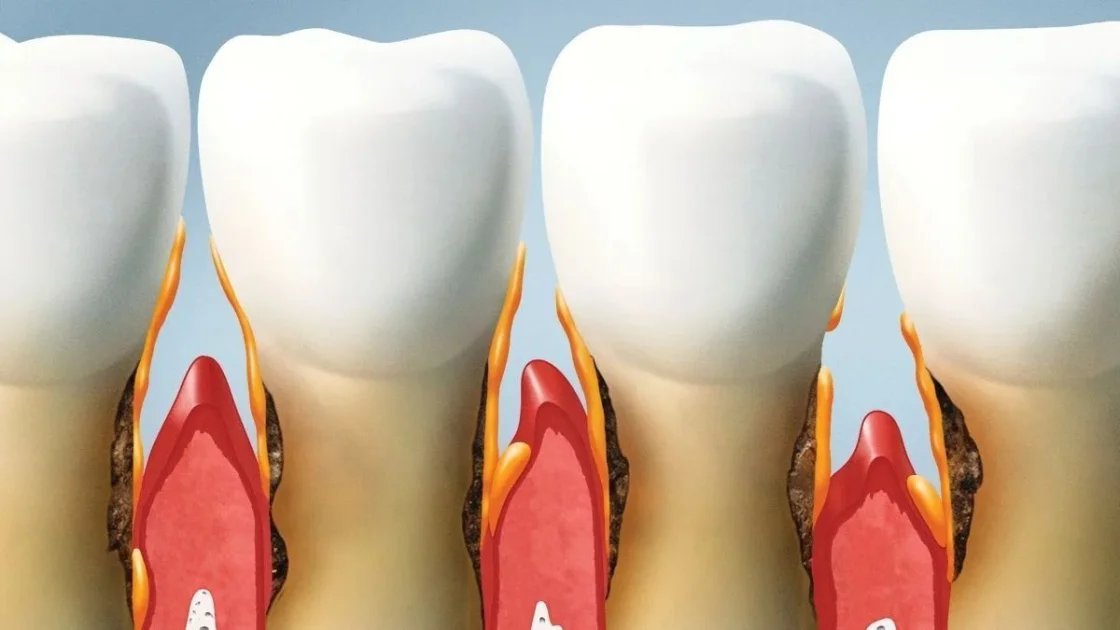 Diş Eti Hastalıkları Tedavisi (Periodontoloji)