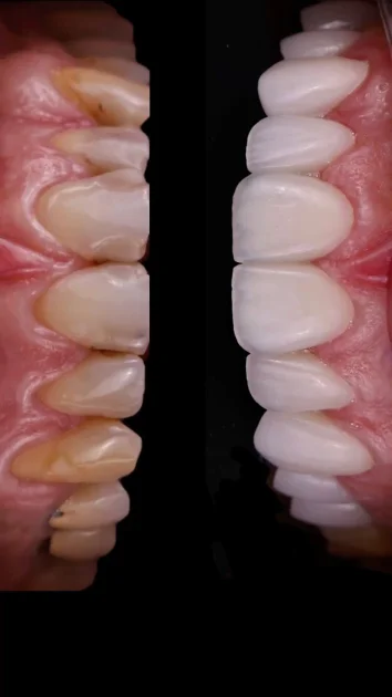 Gülüş Tasarımı Nedir?