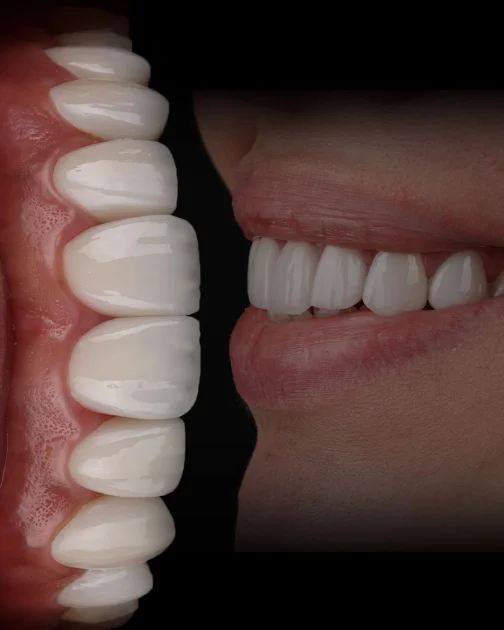 Kompozit Veneer (Direkt Veneer) Tedavileri