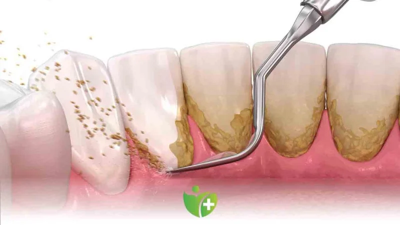 Resim - dis-tasi-c4960789