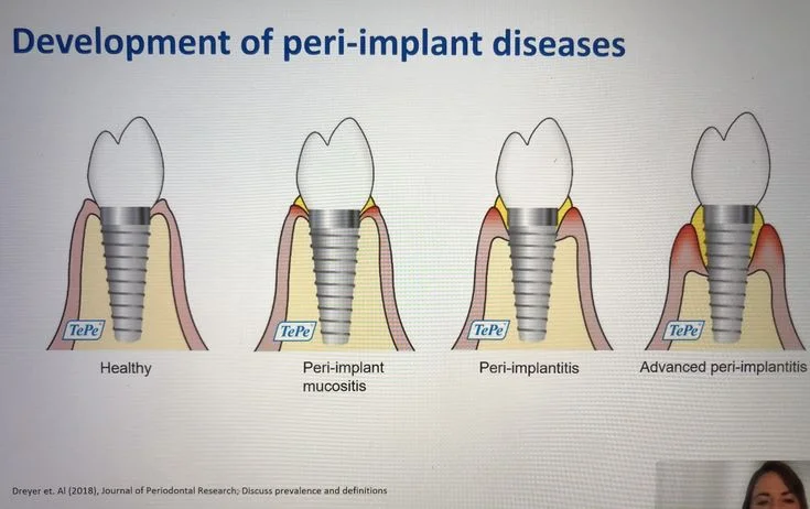 Resim - peri-implantitis1-f3a45c89