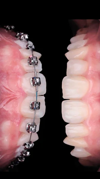 Resim - tel-tedavisi-64c0e290