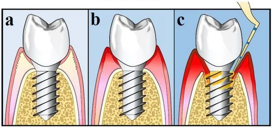 Peri-implantitis yaygınlığı, görülme oranı ve risk faktörleri