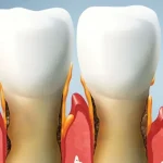 Diş Eti Hastalıkları Tedavisi (Periodontoloji)