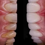 Gülüş Tasarımı Nedir?
