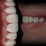 Kompozit Veneer (Direkt Veneer) Tedavileri