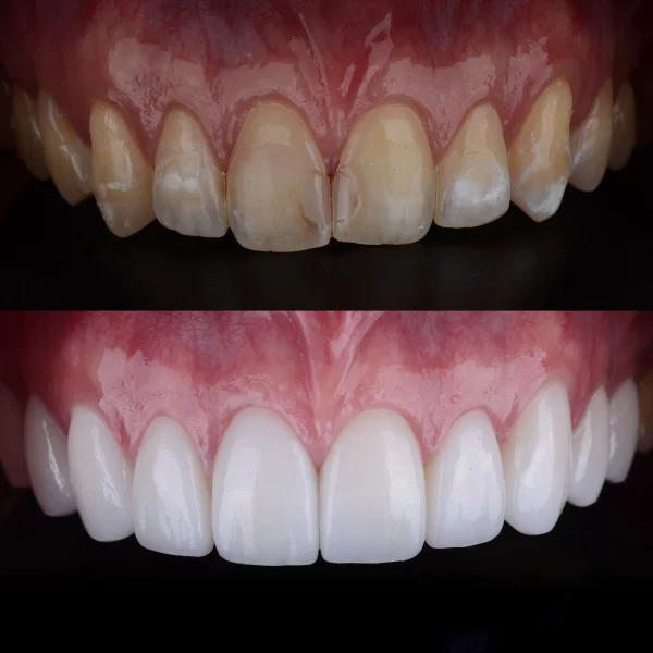 Resim - zirkonyum-96aa4f9e